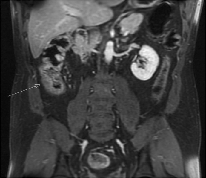 Gastrointestinal Presentation of Eosinophilic Granulomatosis with Polyangiitis, Formerly Churg-Strauss Syndrome: A Case Report.