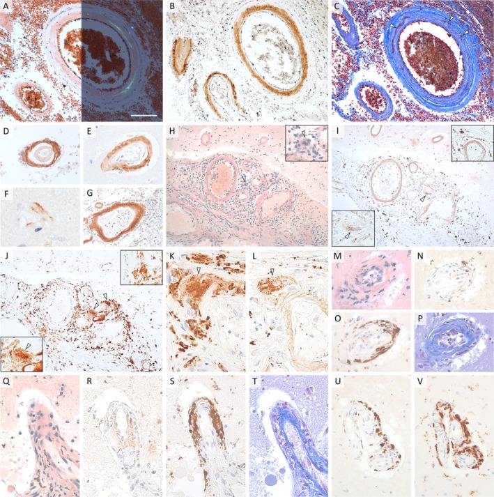 Fatal Outcome of Intravenous Thrombolysis With an Unexpected Finding of Amyloid-β-Related Angiitis-A Case Report Highlighting a Relevant Scenario With Acute Focal Neurological Deficits and Minimal Radiological Presentation.
