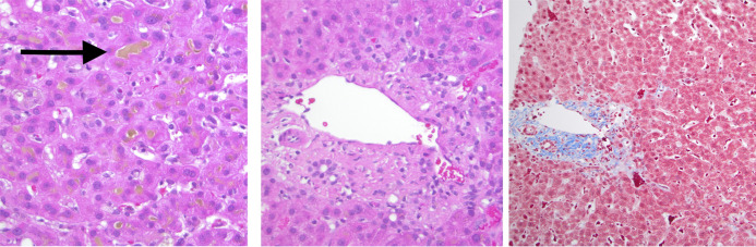 Cholestatic Drug-Induced Liver Injury From Rad-140 Successfully Treated With Corticosteroids.