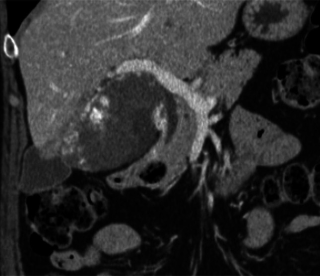 Resistant Hilar Stricture Following Transarterial Bleomycin-Lipiodol Embolization for a Large Hepatic Hemangioma.