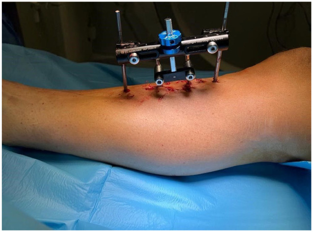A Systematic Review on Tibial Cortex Transverse Transport in the Treatment of Ischemic Ulcers of the Lower Limb.