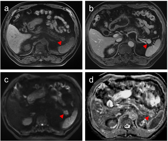 Preoperative MRI and CA19-9 for predicting occult lymph node metastasis in small pancreatic ductal adenocarcinoma (≤ 2 cm).