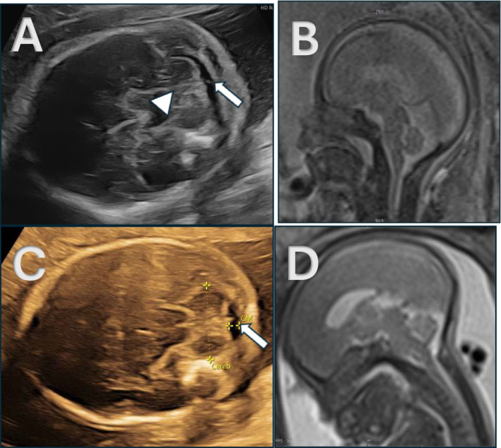 Open Spinal Dysraphism Without Hindbrain Herniation-Natural History and Postnatal Outcome.