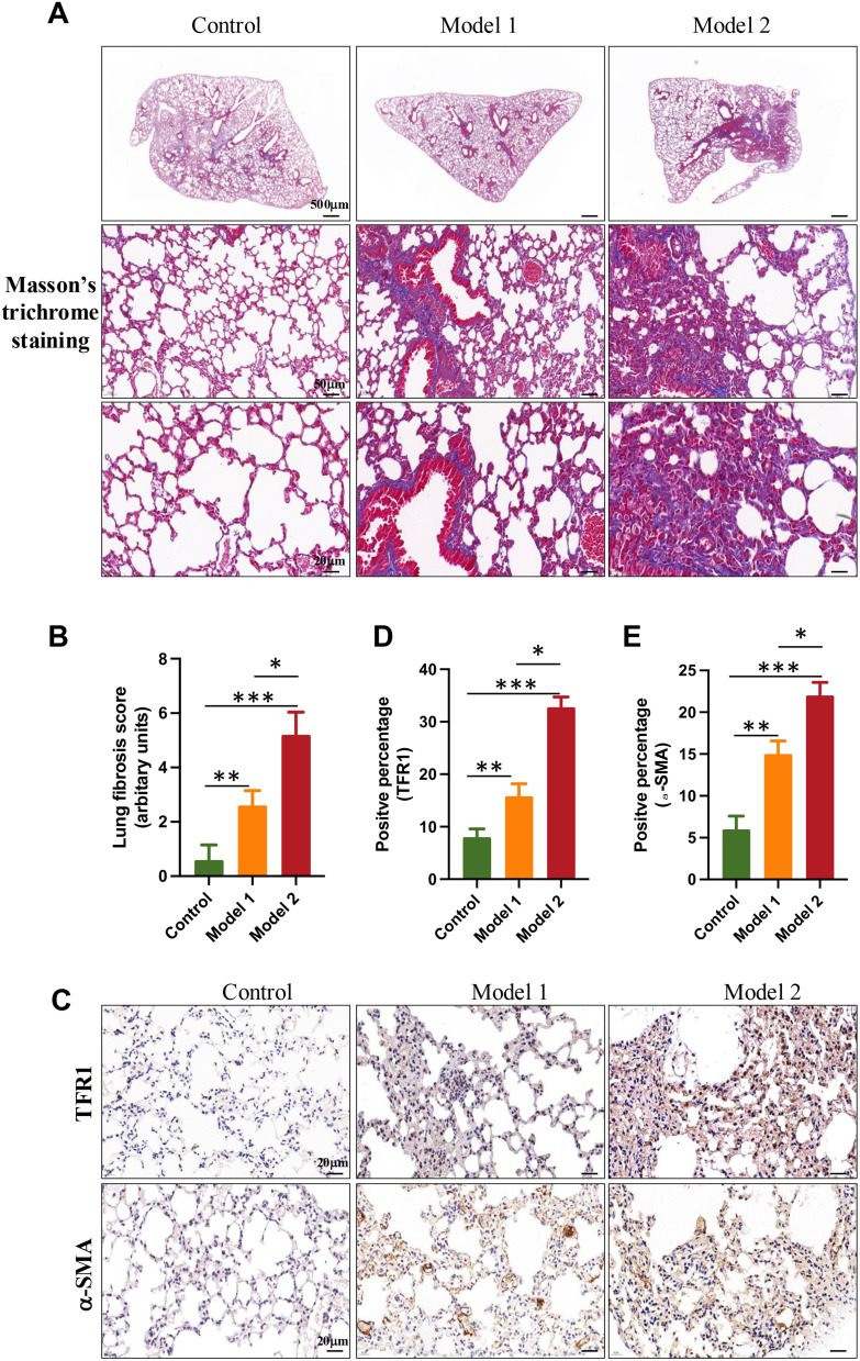 TFR1 as a Biomarker of Pulmonary Fibrosis Development in COPD Patients.