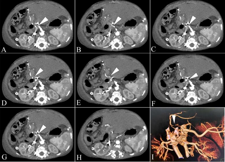 Impending arterial thrombosis in pediatric liver transplantation: Initial experience with alteplase - A case report.