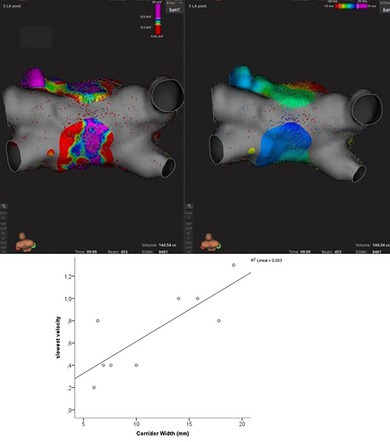 Posterior Wall Involvement During Pulmonary Vein Isolation Using the Farapulse System.
