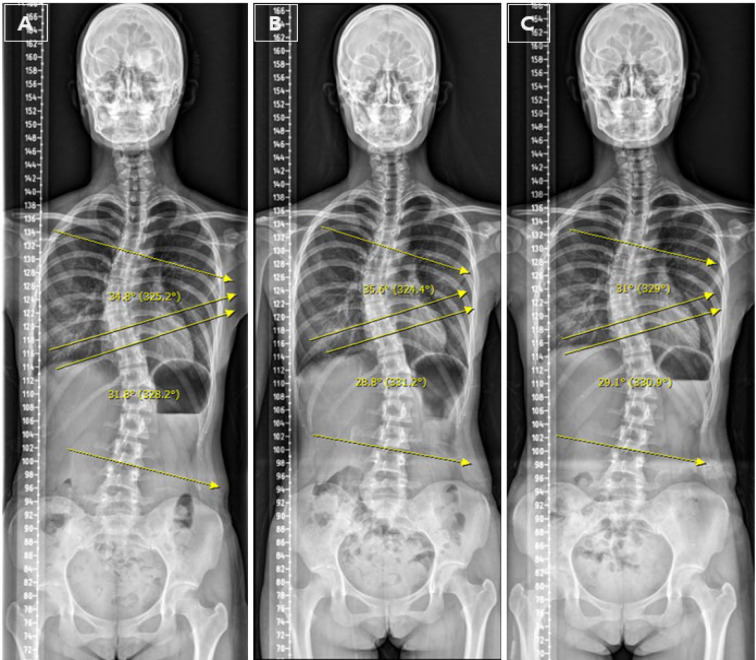 Spontaneous movement therapy for a young adult with adolescent idiopathic scoliosis: a case report.