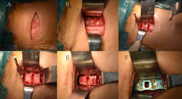 Bone Cement Augmentation for Cervical Vertebrae-Ossification of the Posterior Longitudinal Ligament Complex Contributes to Anterior Controllable Antedisplacement and Fusion in Patients With Osteoporosis.