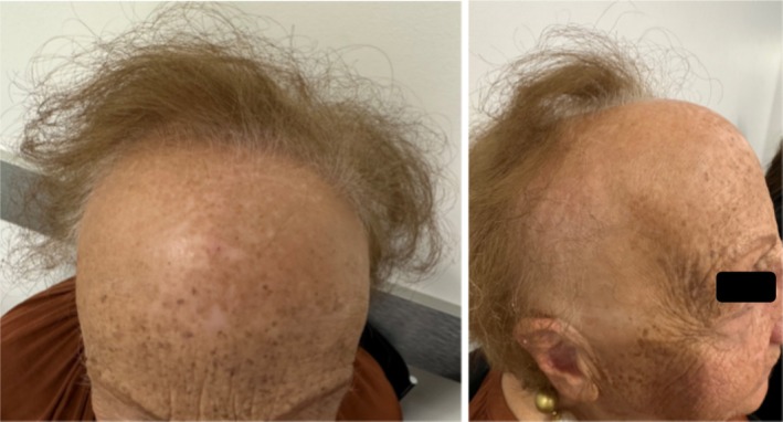 Familial Frontal Fibrosing Alopecia Occurs Early in Daughters With Affected Mothers: A Case Report and a Review of the Literature.