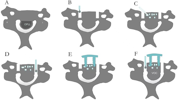 Bone Cement Augmentation for Cervical Vertebrae-Ossification of the Posterior Longitudinal Ligament Complex Contributes to Anterior Controllable Antedisplacement and Fusion in Patients With Osteoporosis.
