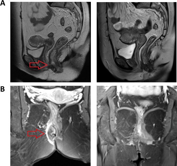 Long-term effectiveness of allogeneic bone marrow-derived mesenchymal stromal cell therapy for complex perianal and rectovaginal fistulas in Crohn's disease: a retrospective case series.