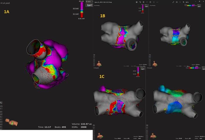 Posterior Wall Involvement During Pulmonary Vein Isolation Using the Farapulse System.