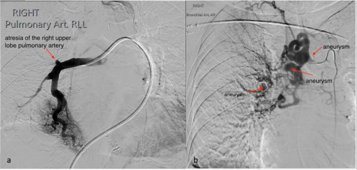 Proximal interruption of the pulmonary artery with systemic bronchial/intercostal aneurysm formation: a case report.