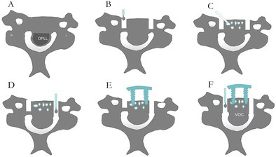 Bone Cement Augmentation for Cervical Vertebrae-Ossification of the Posterior Longitudinal Ligament Complex Contributes to Anterior Controllable Antedisplacement and Fusion in Patients With Osteoporosis.