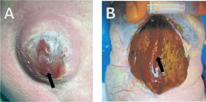 Open Spinal Dysraphism Without Hindbrain Herniation-Natural History and Postnatal Outcome.