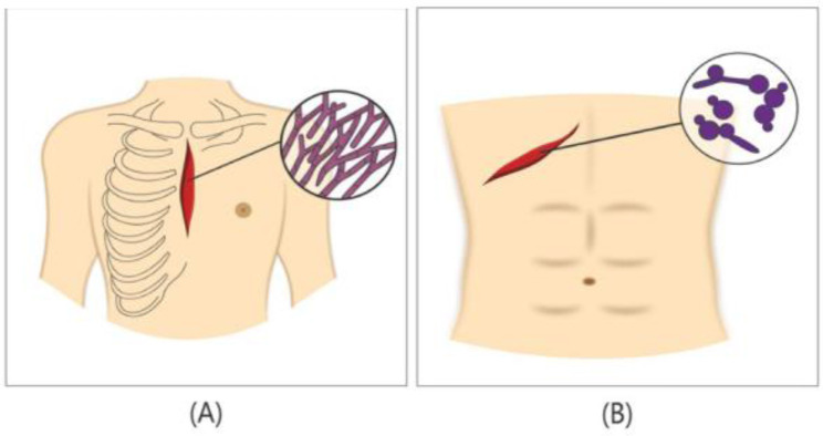A review on fungal surgical site infections: epidemiology, risk factors, main fungal agents, and prevention.