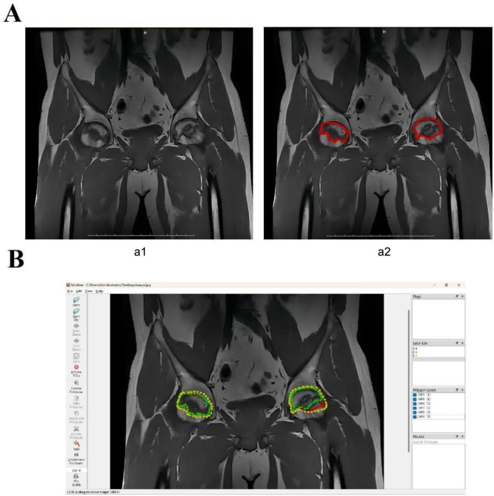 Predictive Modeling of Osteonecrosis of the Femoral Head Progression Using MobileNetV3_Large and Long Short-Term Memory Network: Novel Approach.