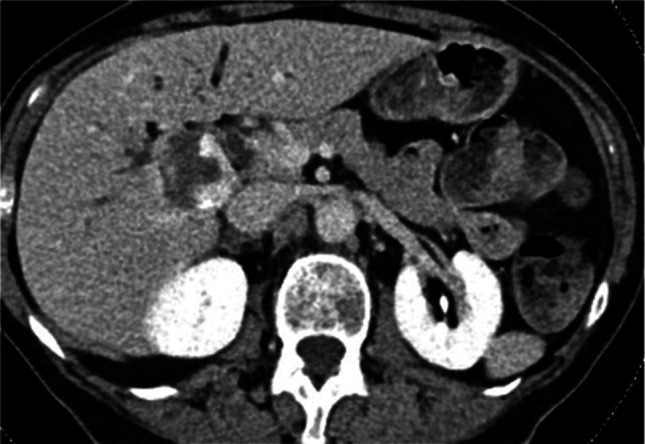 Resistant Hilar Stricture Following Transarterial Bleomycin-Lipiodol Embolization for a Large Hepatic Hemangioma.