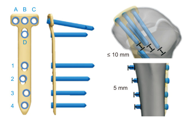 Optimal Plate Position for Biomechanical Stability in Medial Opening-Wedge High Tibial Osteotomy: A Finite Element Analysis.