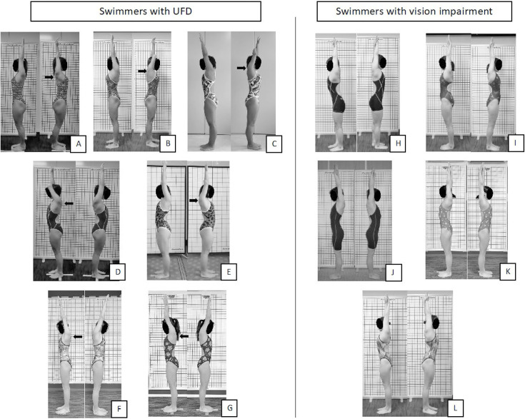 Characteristics of shoulder range of motion, muscle tightness, and streamlined body position in Japanese female para swimmers with unilateral forearm deficiency and in swimmers with vision impairment: a comparative cross-sectional study.