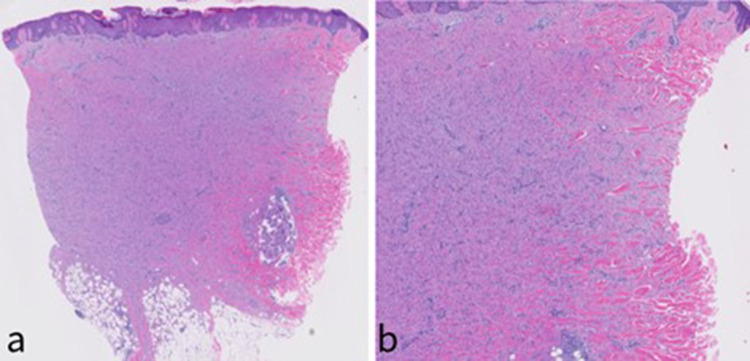 Dermatofibroma: Reappraisal and Updated Review.