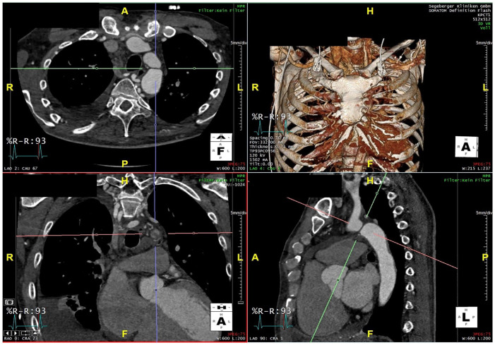 Endovascular Recanalization of Aortic Isthmus Atresia with an "Electrified Wire Technique".