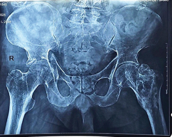 Management of Geriatric Acetabulum Fracture - A Case Report.