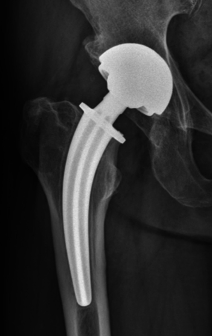 Risk Factors of Aseptic Loosening After Total Hip Arthroplasty With Collum Femoris Preserving Stem: A Long-Term Follow-Up Study.