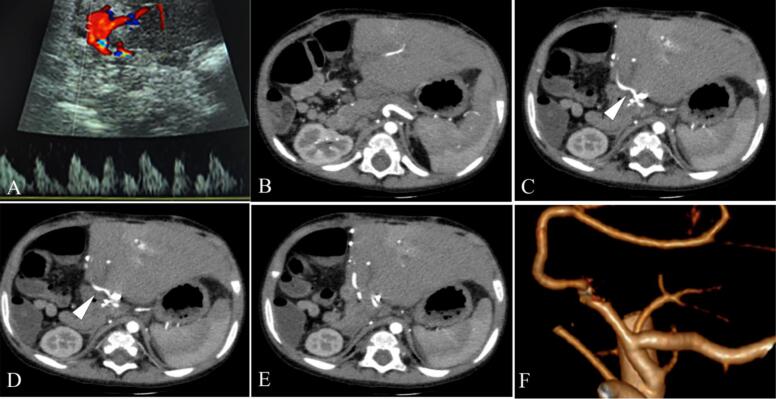 Impending arterial thrombosis in pediatric liver transplantation: Initial experience with alteplase - A case report.