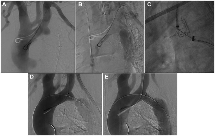 Endovascular Recanalization of Aortic Isthmus Atresia with an "Electrified Wire Technique".
