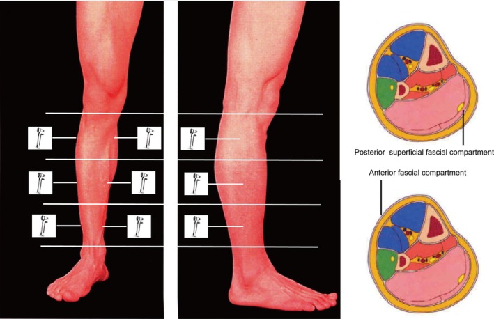 Noninvasive Compartmental Pressure Assessment With iCare in Healthy Individuals of Different Ages.
