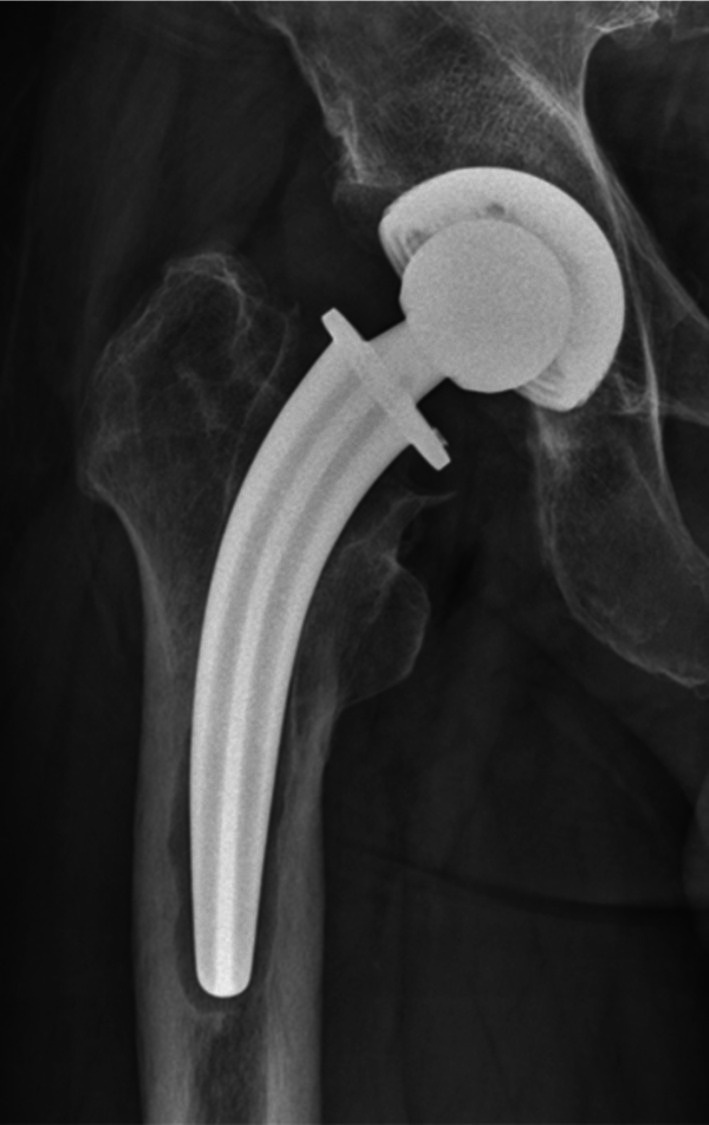 Risk Factors of Aseptic Loosening After Total Hip Arthroplasty With Collum Femoris Preserving Stem: A Long-Term Follow-Up Study.