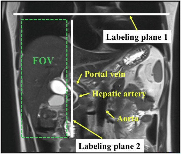 Short-term repeatability and postprandial effect assessment of liver perfusion quantification in healthy subjects using arterial spin labeling MRI.