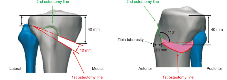Optimal Plate Position for Biomechanical Stability in Medial Opening-Wedge High Tibial Osteotomy: A Finite Element Analysis.