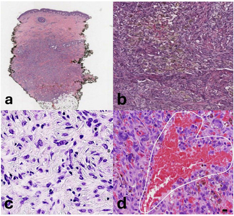 Dermatofibroma: Reappraisal and Updated Review.