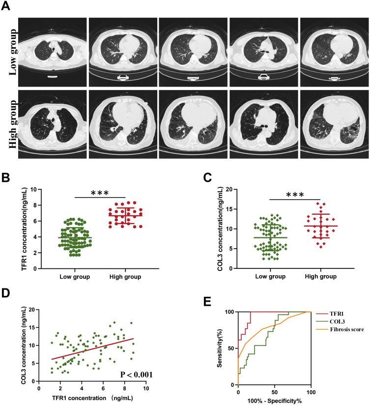 TFR1 as a Biomarker of Pulmonary Fibrosis Development in COPD Patients.