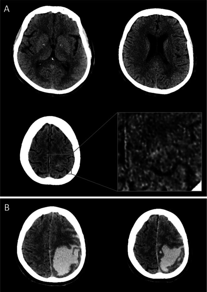 Fatal Outcome of Intravenous Thrombolysis With an Unexpected Finding of Amyloid-β-Related Angiitis-A Case Report Highlighting a Relevant Scenario With Acute Focal Neurological Deficits and Minimal Radiological Presentation.