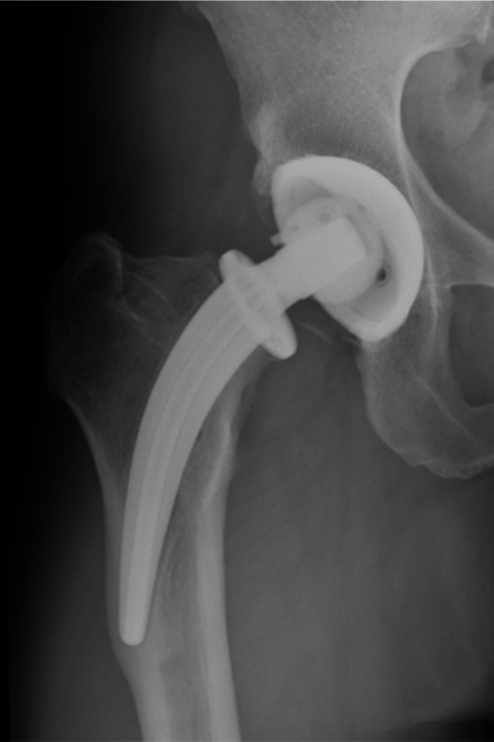 Risk Factors of Aseptic Loosening After Total Hip Arthroplasty With Collum Femoris Preserving Stem: A Long-Term Follow-Up Study.