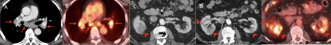IgG4-related disease with interstitial nephritis in a patient with metastatic melanoma following immune checkpoint inhibitor treatment: a case report.