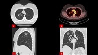 Mycobacterial Infections Mimicking Malignancy in Solitary Pulmonary Lesions: A Cone Beam CT-Guided Biopsy Case Series.