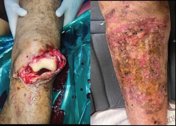 Knee Arthodesis , as a salvage procedure for Non-union of floating knee after ilizarov fixation-A case report.