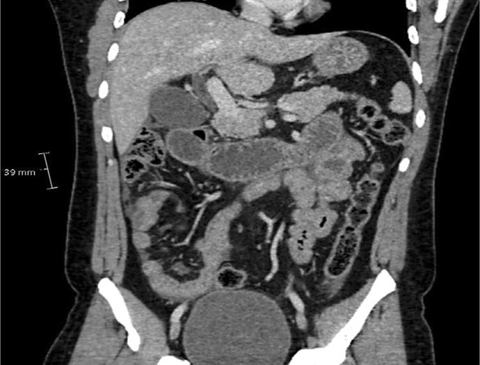 Gastrointestinal Presentation of Eosinophilic Granulomatosis with Polyangiitis, Formerly Churg-Strauss Syndrome: A Case Report.