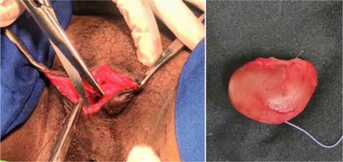 A preventable burden: Clitoral epidermal inclusion cysts following female genital mutilation from resource limiting settings - A case series and literature review.