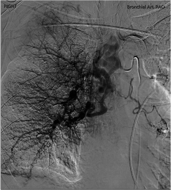 Proximal interruption of the pulmonary artery with systemic bronchial/intercostal aneurysm formation: a case report.