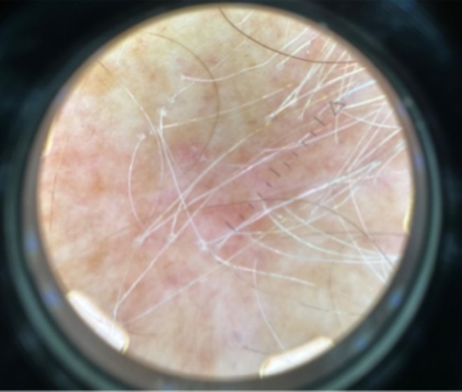 Familial Frontal Fibrosing Alopecia Occurs Early in Daughters With Affected Mothers: A Case Report and a Review of the Literature.