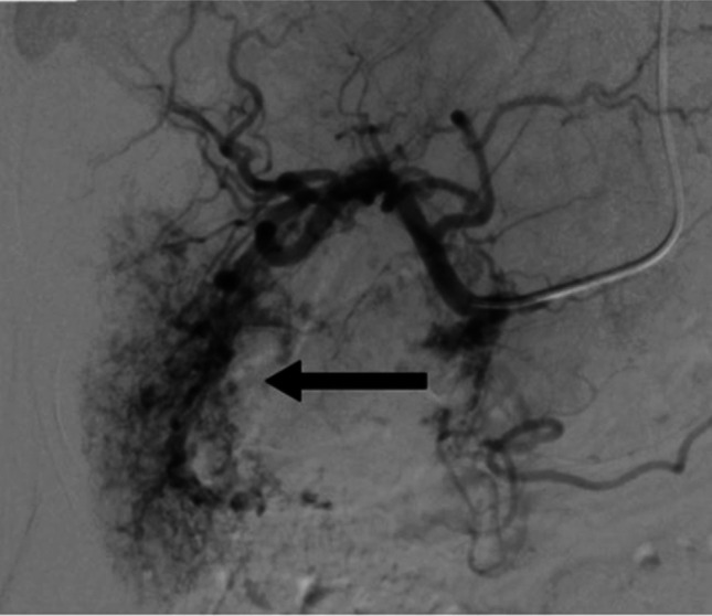Resistant Hilar Stricture Following Transarterial Bleomycin-Lipiodol Embolization for a Large Hepatic Hemangioma.