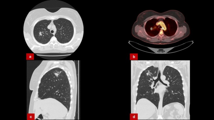 Mycobacterial Infections Mimicking Malignancy in Solitary Pulmonary Lesions: A Cone Beam CT-Guided Biopsy Case Series.