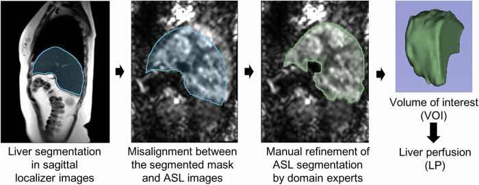 Short-term repeatability and postprandial effect assessment of liver perfusion quantification in healthy subjects using arterial spin labeling MRI.