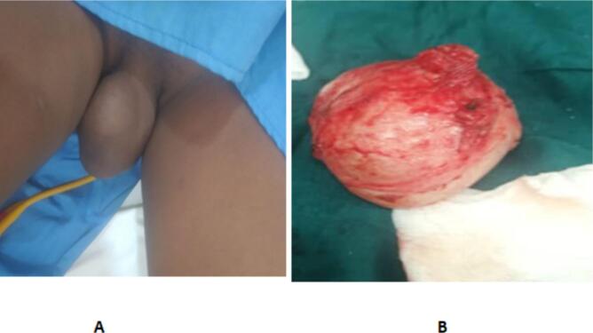 A preventable burden: Clitoral epidermal inclusion cysts following female genital mutilation from resource limiting settings - A case series and literature review.