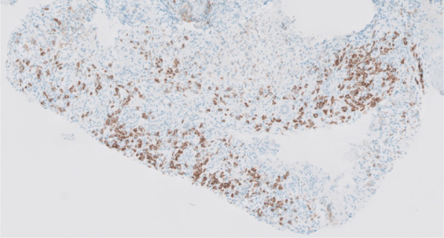 IgG4-related disease with interstitial nephritis in a patient with metastatic melanoma following immune checkpoint inhibitor treatment: a case report.